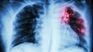 Córdoba reportó 140 casos de tuberculosis en 2024. 
