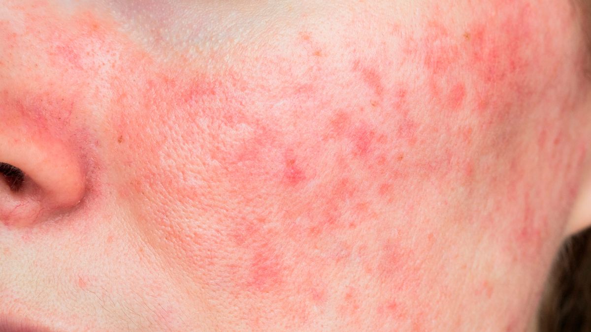 Bye bye rosacea: the best trick from experts to get rid of facial redness