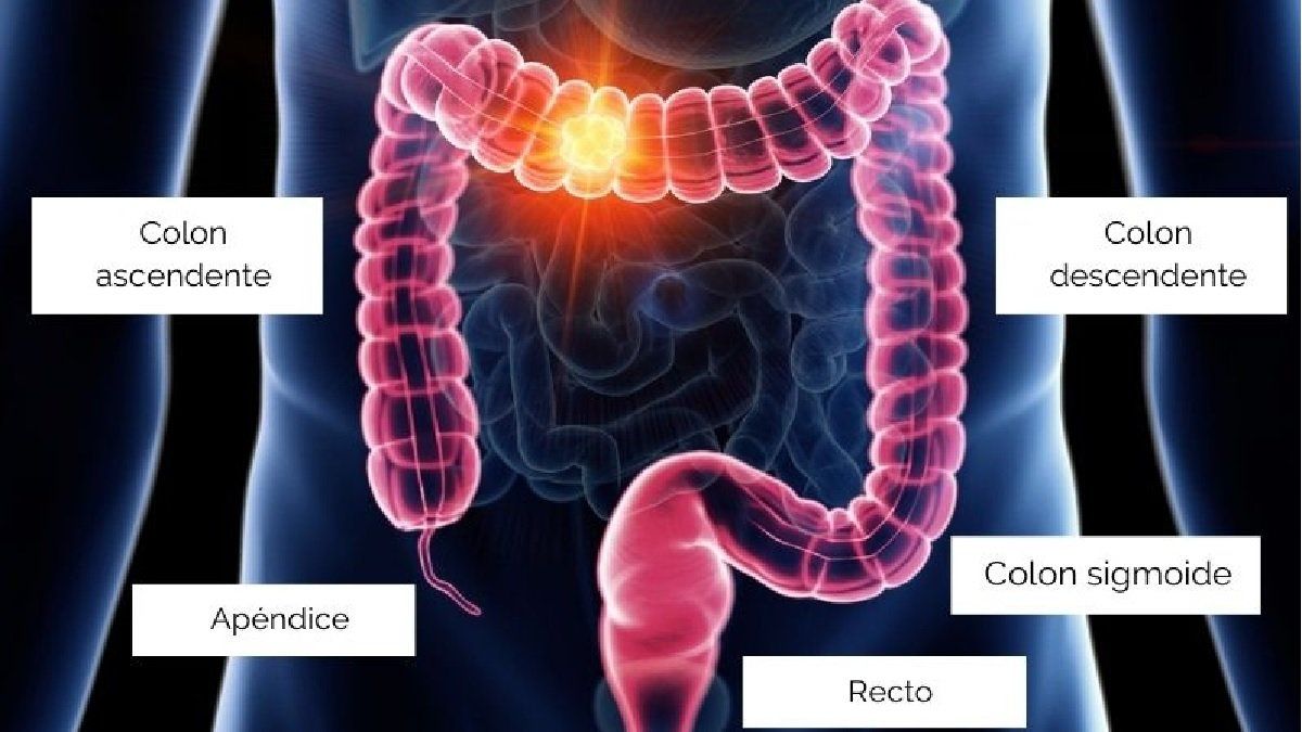 Cáncer: un estudio clínico remitió el cáncer de colon en 18 pacientes