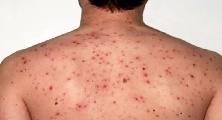 El brote que está en curso en Canadá registra al menos 4.748 casos confirmados en lo que va del año.