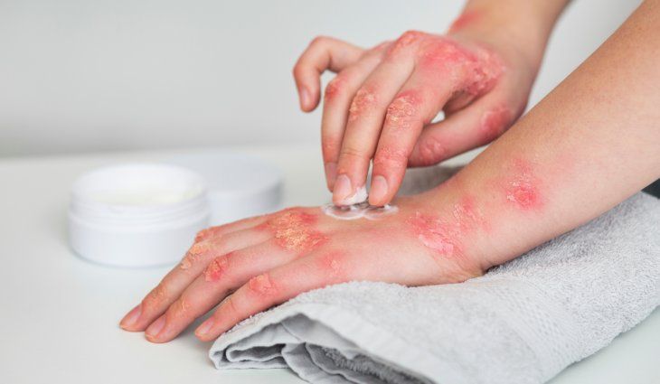 Some of the main complications it causes are skin ulcers and a lot of itching. Some of the main complications it causes are skin ulcers and a lot of itching.
