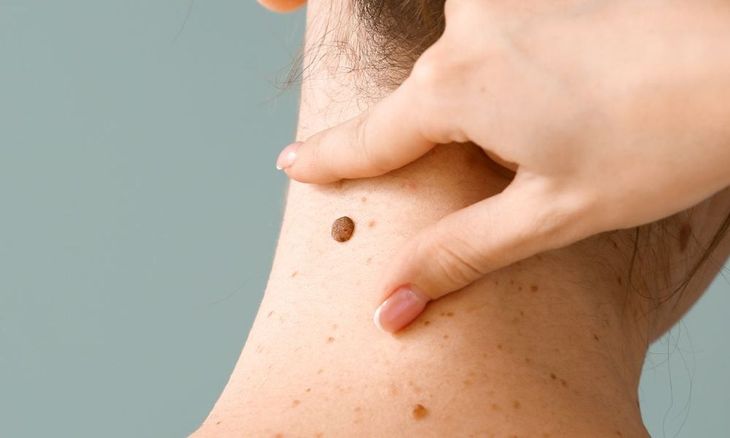 Facundo Arana said that he has skin cancer: “If we reach an early diagnosis, it can be a procedure”