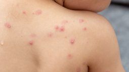 New cases of monkeypox in the City of Buenos Aires.