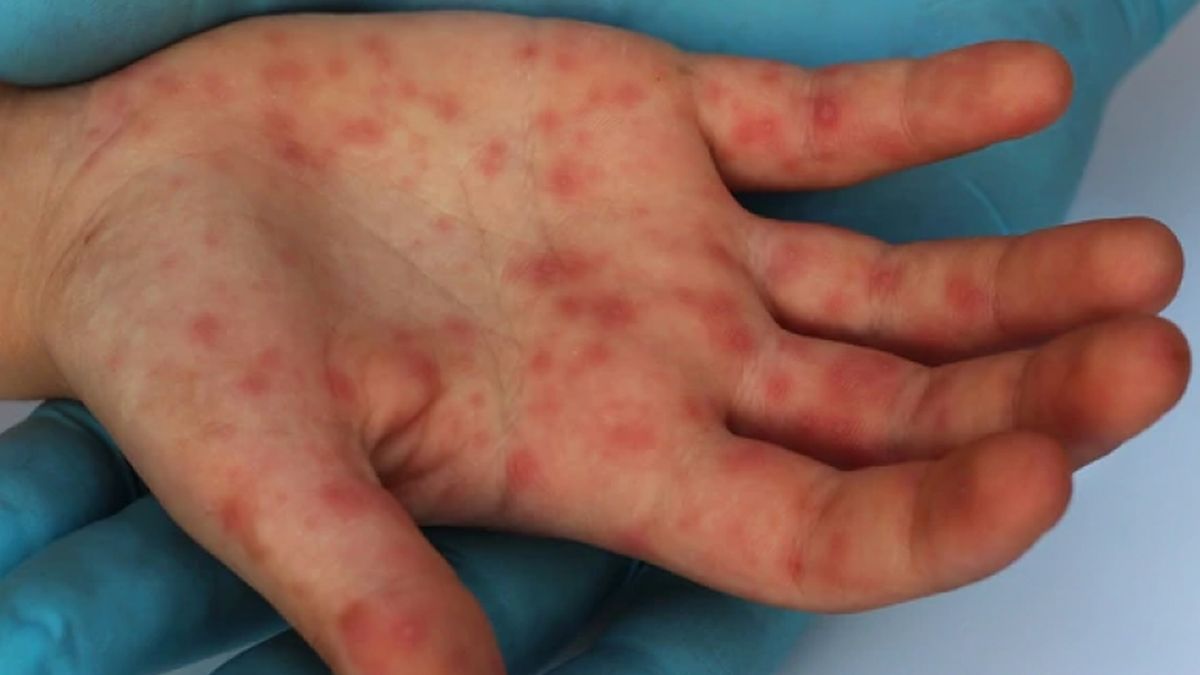 El sarampión se convirtió en una amenaza mundial inminente debido a la pandemia
