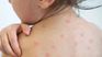 The little boy developed fever, then cough, rhinitis, conjunctivitis and Koplic spots two days after arriving in Argentina, but is progressing favorably without requiring hospitalization and continues with home isolation and clinical monitoring, as confirmed by the authorities. The little boy developed fever, then cough, rhinitis, conjunctivitis and Koplic spots two days after arriving in Argentina, but is progressing favorably without requiring hospitalization and continues with home isolation and clinical monitoring, as confirmed by the authorities.