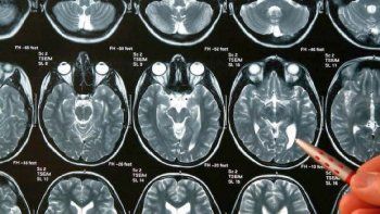 la muerte de gerardo rozin: ¿como se tratan los tumores cerebrales?