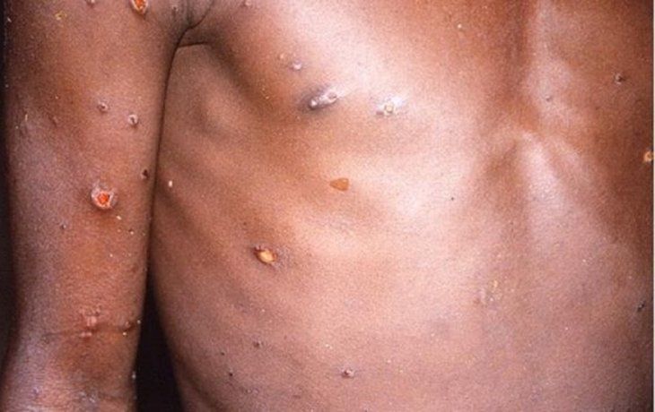 Aseguran que es muy bajo riesgo de que viruela del mono se vuelva pandemia