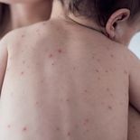 El Ministerio de Salud informó que no hubo nuevos casos de Sarampión. El Ministerio de Salud informó que no hubo nuevos casos de Sarampión.