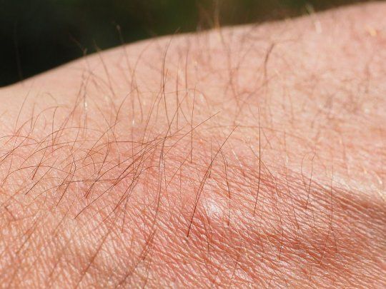 urticaria cronica 1200.jpg