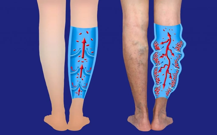 The chronic venous insufficiency suffered by Donald Trump is considered “benign and current The chronic venous insufficiency suffered by Donald Trump is considered “benign and current