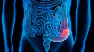 La investigación analizó a 88.092 adultos estadounidenses sin antecedentes de cáncer, participantes en el ensayo de detección de cáncer de próstata, pulmón, colorrectal y ovario (PLCO).