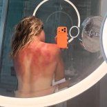 Una tenista encendió las alarmas en el Abierto de Australia por las quemaduras del Sol en su espalda Una tenista encendió las alarmas en el Abierto de Australia por las quemaduras del Sol en su espalda