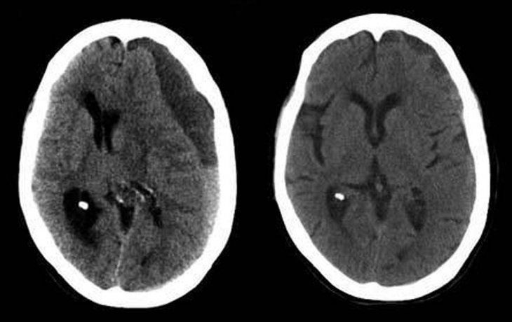 Hematoma subdural crónico.
