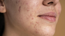 Demystifying that acne is only a thing for young people. 