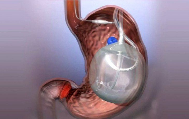 ámbito.com | Balón Gástrico 2.jpg