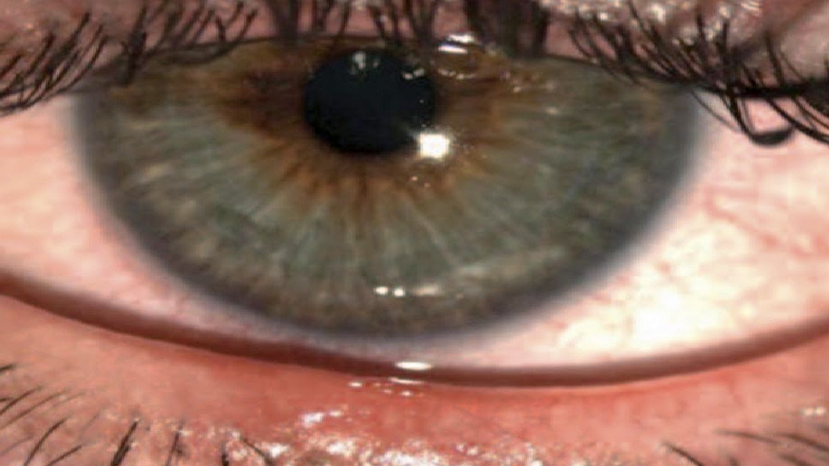 3 in 4 Rosacea Patients May Have Eye Damage