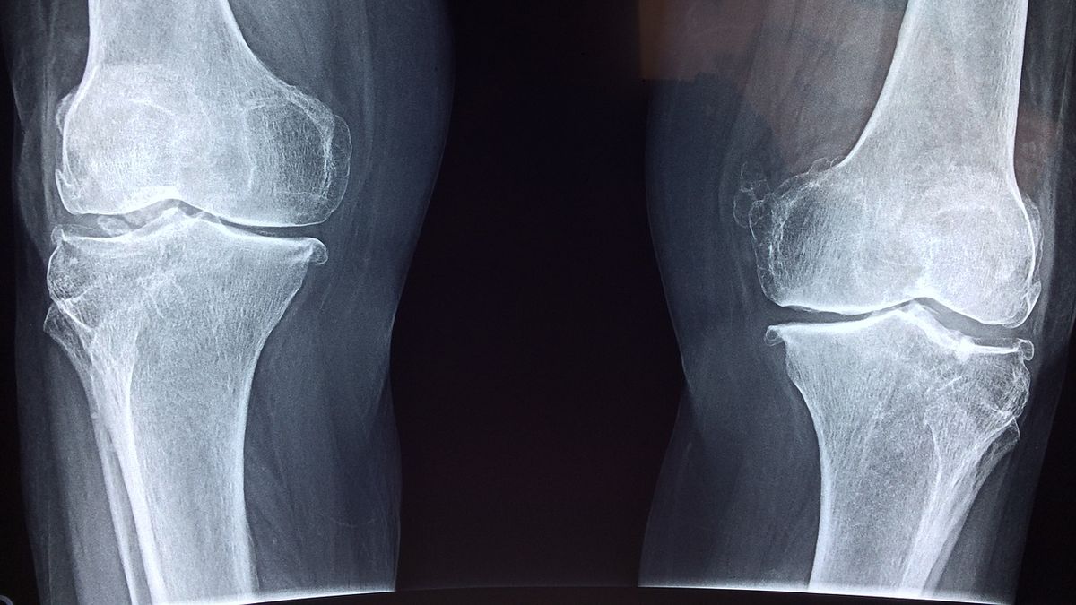 Día Mundial de la Osteoporosis: cómo prevenir la enfermedad que causa 90 fracturas de cadera por día