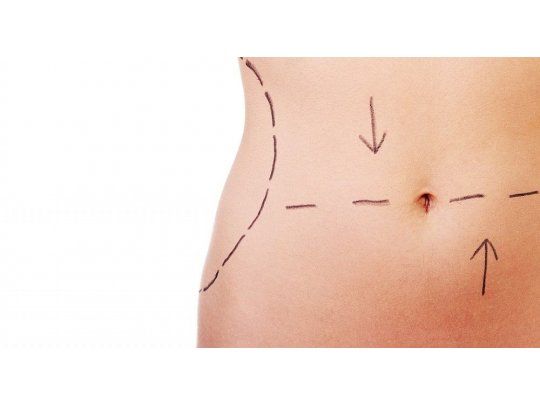 Seis preguntas típicas sobre la lipoaspiración