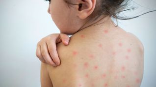 La OMS en alerta por el aumento de casos de sarampión en Europa