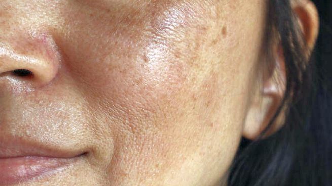 Melasma.jpg