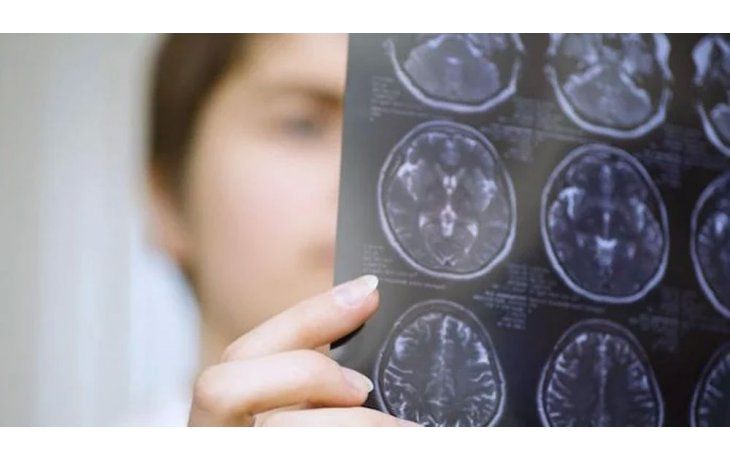 A pesar de atacar a la misma parte del cuerpo, ELA y esclerosis múltiple son enfermedades distintas. A pesar de atacar a la misma parte del cuerpo, ELA y esclerosis múltiple son enfermedades distintas.