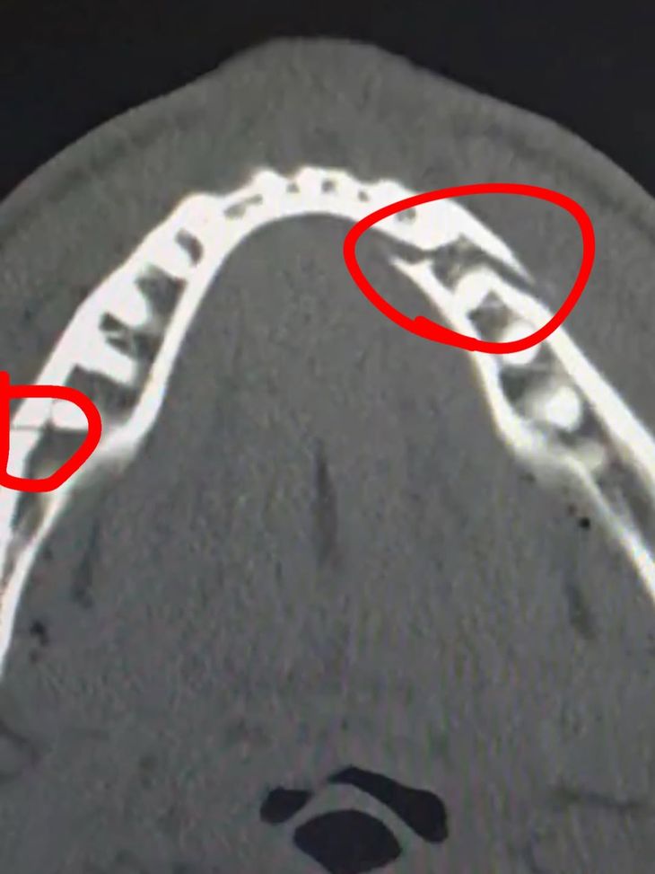 "Por cierto, creo que me romp&iacute; la mand&iacute;bula&rdquo;, asegur&oacute; inmediatamente despu&eacute;s del combate.