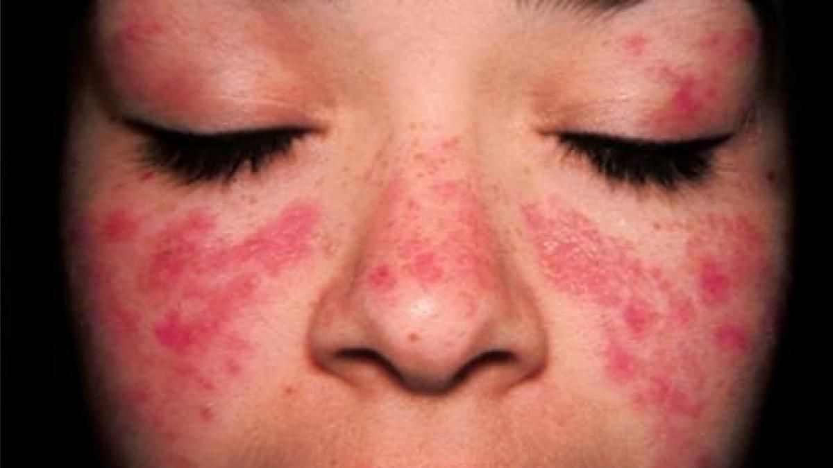 Lupus: the innovative therapy against this disease Lupus: the innovative therapy against this disease