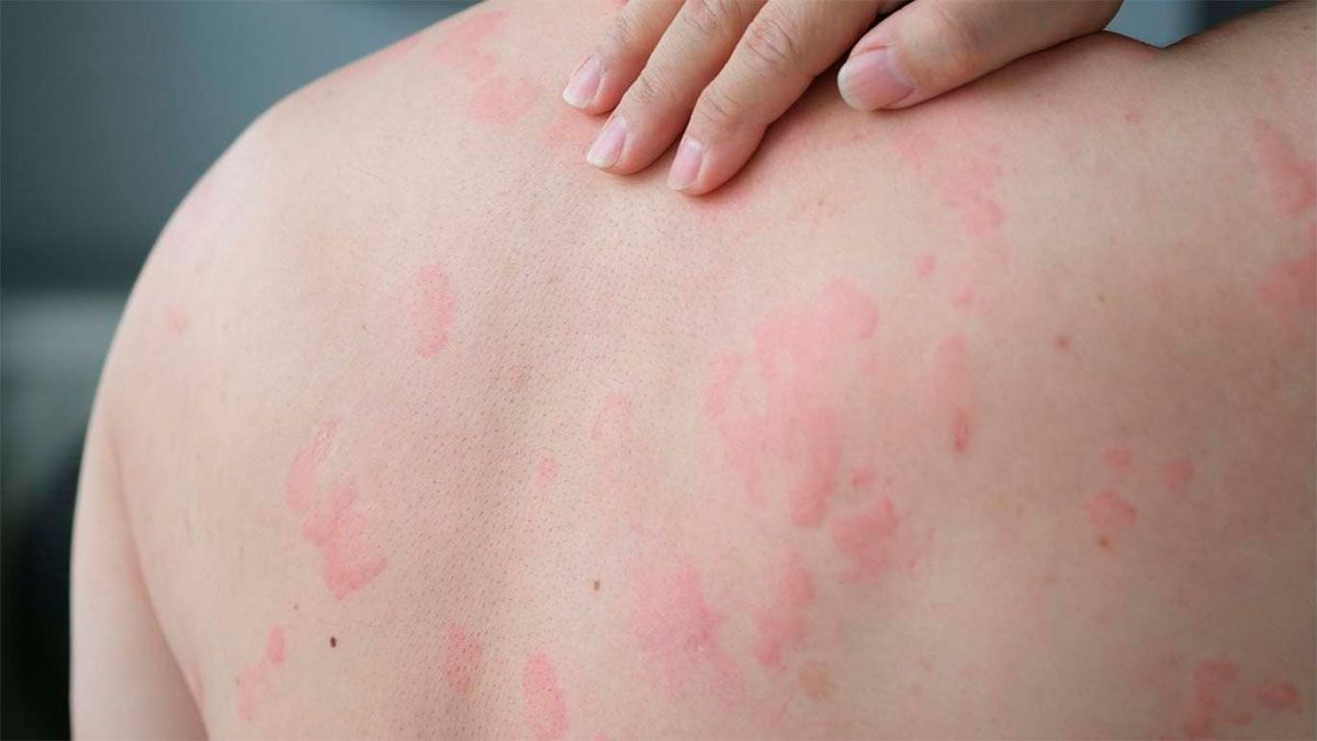 Chronic urticaria, everything about the hive disease that affects 100,000 Argentines