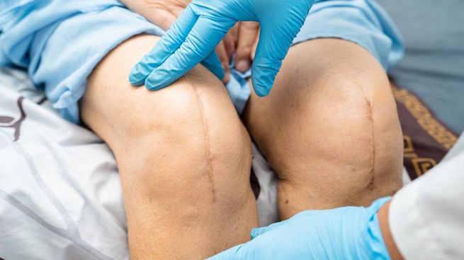 La ANMAT prohibió en todo el país el tornillo traumatológico “SPIN® 2.0” por no contar con registro sanitario.