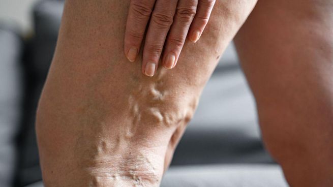 La trombosis venosa profunda es una afección que ocurre cuando se forma un coágulo de sangre en una vena profunda