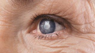 En todos los tipos de glaucoma, el nervio que conecta el ojo con el cerebro está dañado, generalmente debido a una presión ocular elevada.