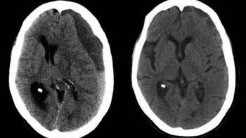Hematoma subdural crónico.