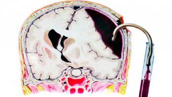 video: medico neurocirujano explico como se tratan los hematomas subdurales