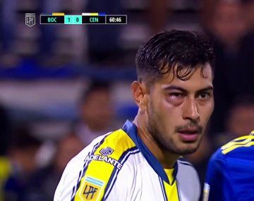 Así quedó el ojo de Emmanuel Ojeda tras el cobarde golpe de Diego González.