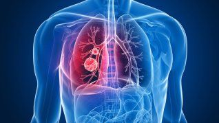 Crecen los casos de enfermedades respiratorias en Argentina. Crecen los casos de enfermedades respiratorias en Argentina.
