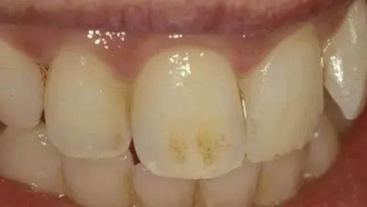 Paso a paso: método casero para eliminar las manchas amarillas de los dientes Paso a paso: método casero para eliminar las manchas amarillas de los dientes