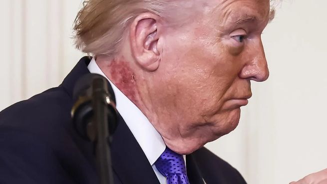 La lesión rojiza fue visible debajo de la oreja derecha durante recientes actos públicos.