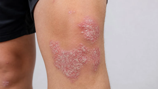 &nbsp;Las lesiones suelen aparecer en codos, rodillas y cuero cabelludo. El diagnóstico dermatológico permite definir el tratamiento según la gravedad.