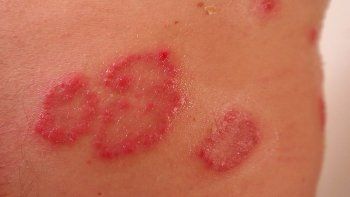 ámbito.com | psoriasis nueva_1000.jpg