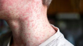 La provincia de Buenos Aires registró 21 casos de sarampión. La provincia de Buenos Aires registró 21 casos de sarampión.