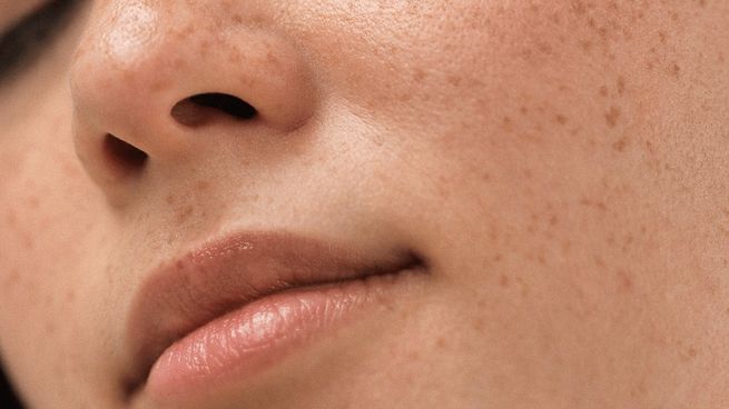 Las manchas solares o hiperpigmentaciones son causadas por la exposición desprotegida al Sol.