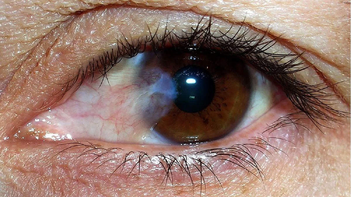 es la catarata ocular, a quiénes afecta y cómo es la cirugía para curarlas