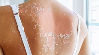 Después de la quemadura, lo ideal es mantener la piel hidratada y usar paños fríos para evitar el ardor. Después de la quemadura, lo ideal es mantener la piel hidratada y usar paños fríos para evitar el ardor.