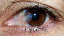 Waterfalls. The most common symptoms are glare, altered color and contrast vision, and progressive decrease in vision. Waterfalls. The most common symptoms are glare, altered color and contrast vision, and progressive decrease in vision.