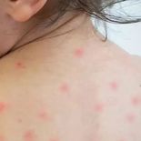 Las autoridades piden revisar las dosis obligatorias de la vacuna del sarampión ante la baja cobertura que afecta a niños y adultos. Las autoridades piden revisar las dosis obligatorias de la vacuna del sarampión ante la baja cobertura que afecta a niños y adultos.