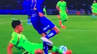 Alan Medina, jugador de Pumas, sufrió una grave lesión durante el partido ante FC Juárez. Tuvo fractura de tobillo izquierdo y será operado Alan Medina, jugador de Pumas, sufrió una grave lesión durante el partido ante FC Juárez. Tuvo fractura de tobillo izquierdo y será operado