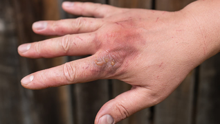 ámbito.com | quemadura piel mano