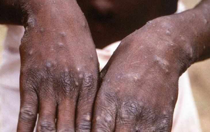 viruela del mono: preocupacion en canada tras detectar diez nuevos casos del virus