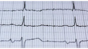 Por primera vez, implantan desfibrilador subcutáneo a un adolescente