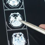 El estudio analizó más de 9.400 casos y detectó cambios en la sustancia blanca cerebral. El estudio analizó más de 9.400 casos y detectó cambios en la sustancia blanca cerebral.